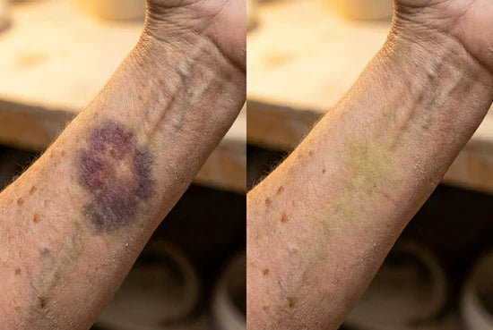 Wrist bruise appearance before and after cosmetic comparison