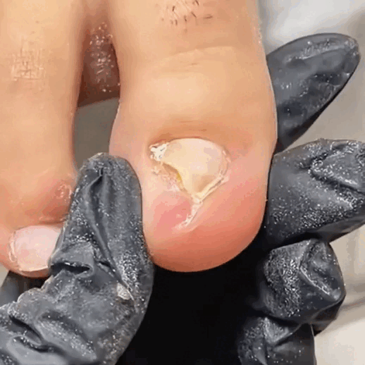 Nail repair applicator demonstration