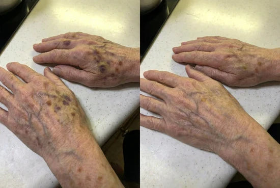 Hands before and after cosmetic appearance comparison