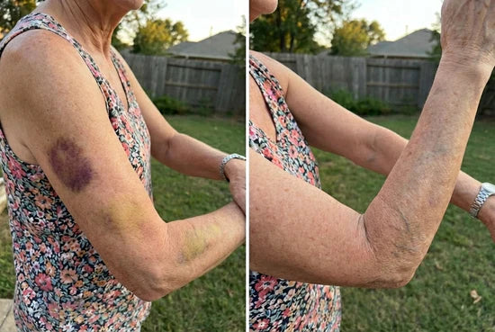 Upper arm before and after cosmetic comparison