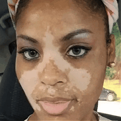 Close-up portrait showing naturally visible areas of reduced skin pigmentation