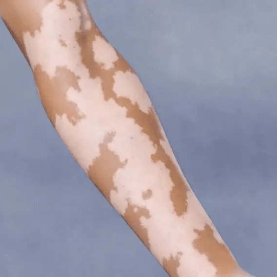 Animated illustration of an arm with pigmentation differences and a stylized skin cross-section
